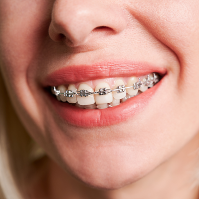woman with metal braces on teeth woman with metal braces on teeth