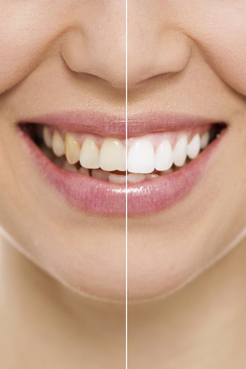 Before And After - Teeth Whitening